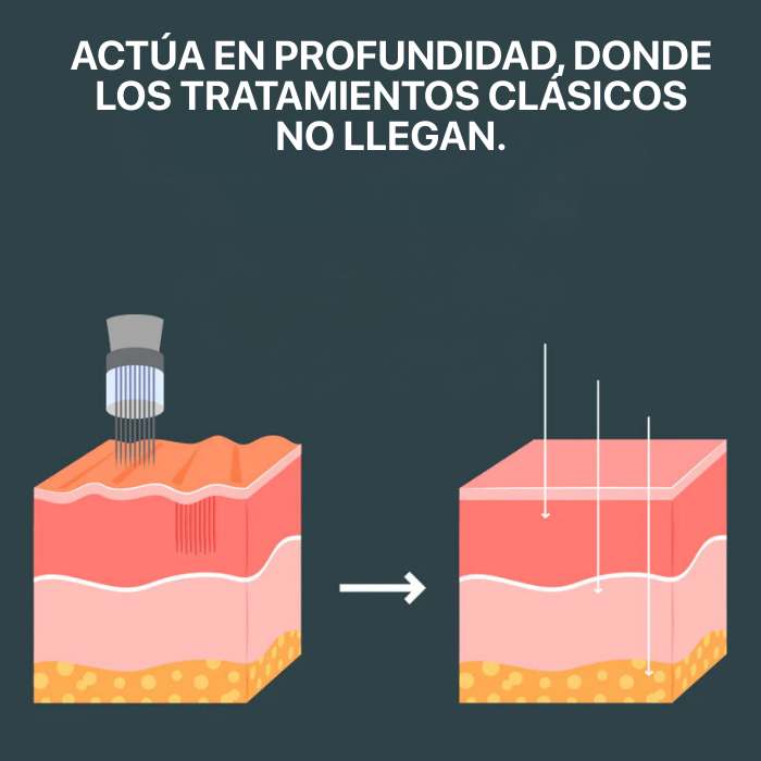 El Sistema de Microinfusión™